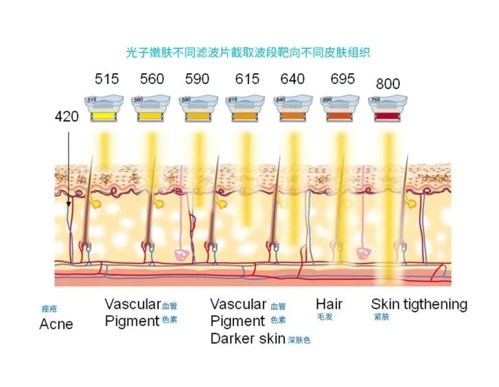 五大光子嫩膚技術(shù)（IPL、DPL、OPT、APT、BBL）及濾光片區(qū)別